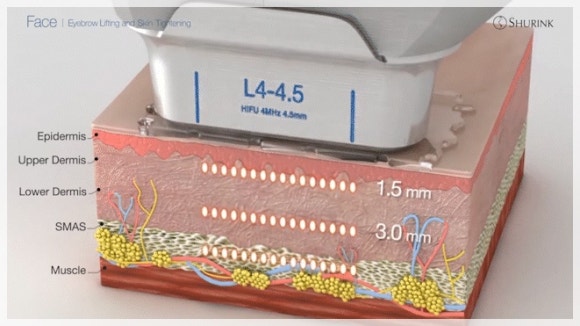 영등포역 슈링크 이렇게 받아야 효과 있습니다 관련 이미지 5