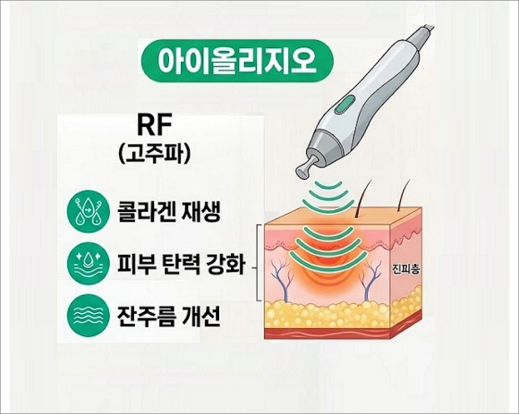 아이슈링크 vs. 아이올리지오 뭐가 좋을까 관련 이미지 4