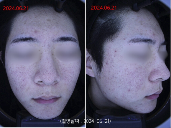 영등포 여드름 치료 사례 군대 전역 후 악화된 트러블 개선 관련 이미지 1