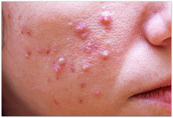 영등포역 근처 피부과 진료, 재발하는 여드름은 어떻게 관리해야 할까? 관련 이미지 1