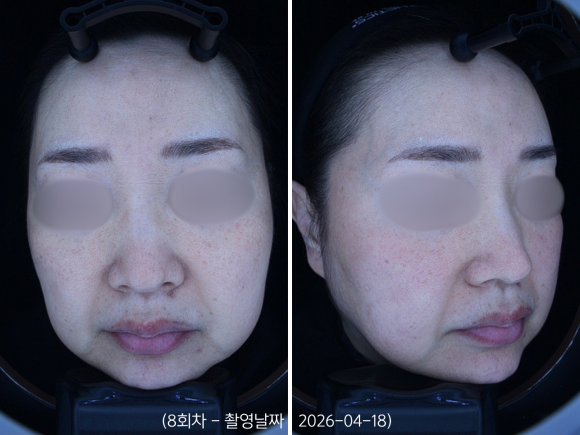 영등포 홍조치료, 안면홍조 레이저 받으면 붉은기가 좋아지나요? 관련 이미지 6