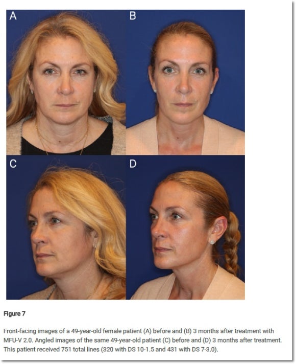 울쎄라피프라임 효과, 울쎄라랑 비교하면? 관련 이미지 5