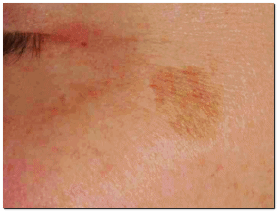 영등포 피부과 점빼기, 점 재발이 걱정된다면? 관련 이미지 3