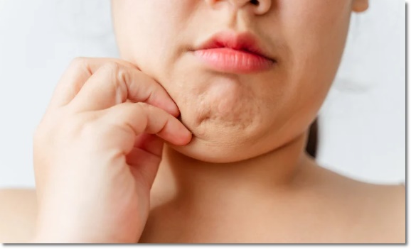 온다리프팅 이중턱 정리 효과, 어느 정도일까? 관련 이미지 1