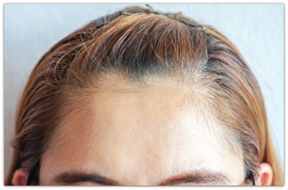 영등포역 필러 피부과 진료, 벨로테로 이마 팔자주름 효과, 그리고 중요한 것은? 관련 이미지 4