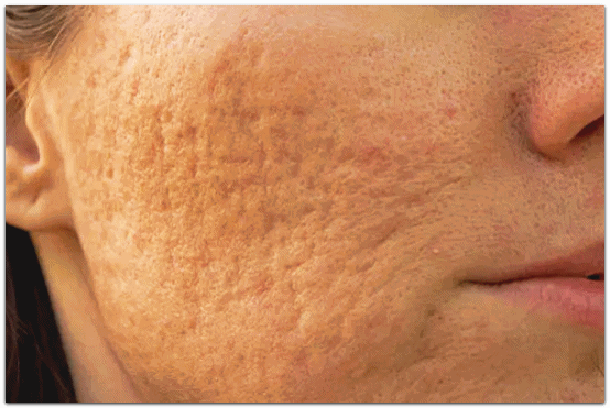 영등포여드름피부과 남자 여드름은 어떻게 치료해야 할까? 관련 이미지 13