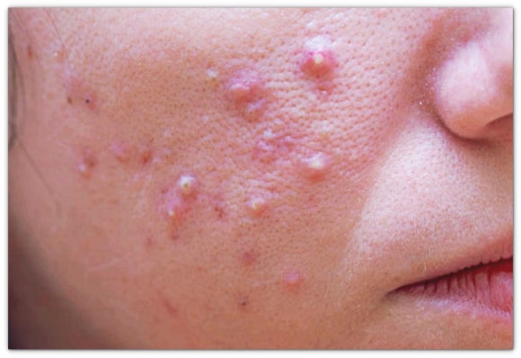 영등포여드름치료, 시술로 효과 보려면? 관련 이미지 4