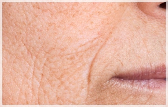 얼굴주름리프팅 시술 효과 좋은 건? 관련 이미지 1