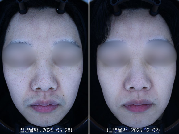 Yeongdeungpo Melasma and Dark Spots, How Many Laser Toning Sessions Will It Take? image 5