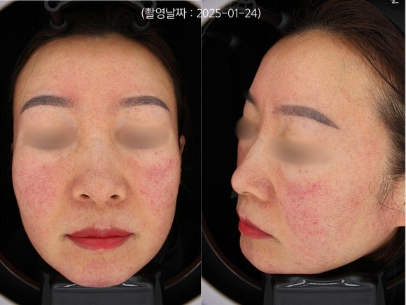 영등포 레이저토닝으로 홍조 치료한 사례 관련 이미지 2