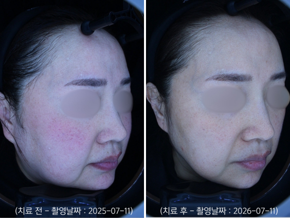 영등포 홍조치료, 안면홍조 레이저 받으면 붉은기가 좋아지나요? 관련 이미지 8