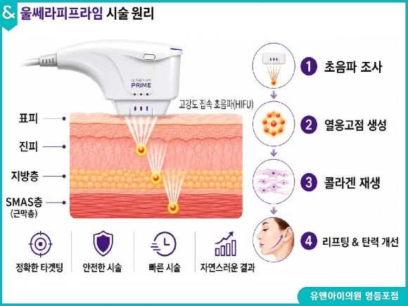 울쎄라피프라임 vs 써마지, 어떤 게 좋을까? 관련 이미지 2