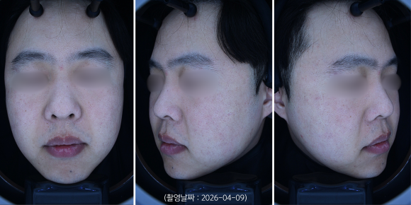 A Yeongdeungpo Man’s Blemishes and Enlarged Pores: How Were They Actually Treated? image 3