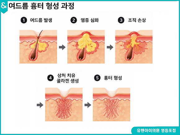 Yeongdeungpo Acne Scars: If They Concern You, You Need to Identify the Cause First image 2