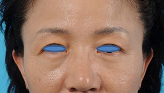 눈밑처짐 리프팅 아이울쎄라로 가능할까? 관련 이미지 2