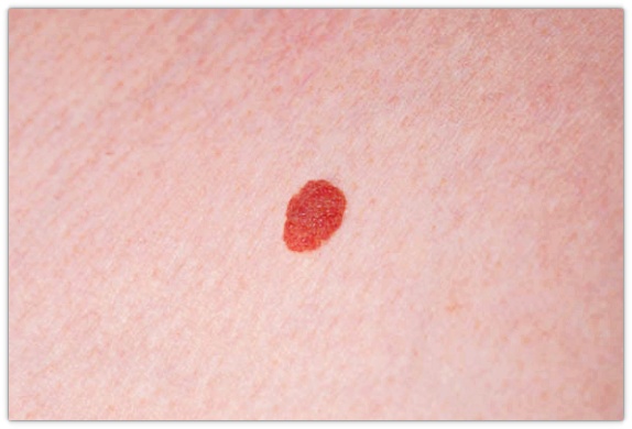 영등포점제거 깔끔하게 점빼기 가능할까? <재발 관련 내용 포함> 관련 이미지 3