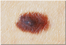 영등포 피부과 점빼기, 점 재발이 걱정된다면? 관련 이미지 1