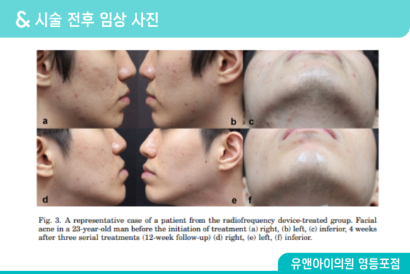 Yeongdeungpo Acne Treatment: What Should You Look at First When Acne Keeps Coming Back? image 5