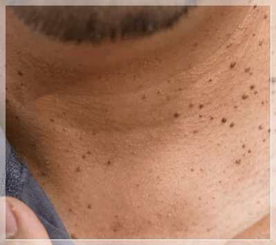 Why Flat Warts Should Be Compared First Before Undergoing Skin Tag Removal in Yeongdeungpo image 2