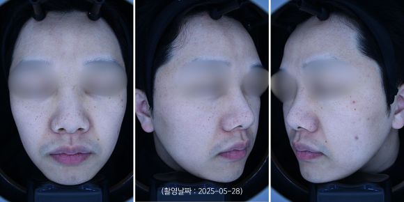 Yeongdeungpo Melasma and Dark Spots, How Many Laser Toning Sessions Will It Take? image 2
