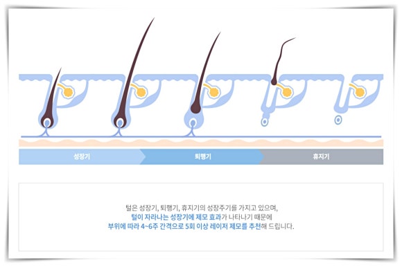 영등포역제모 겨드랑이 레이저 관련 이미지 5