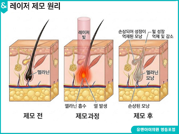 영등포역레이저제모, 시술 전 남성분들이 반드시 알아야 할 정보 관련 이미지 2
