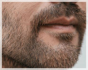 Yeongdeungpo GentleMax Pro Plus: Why Is Satisfaction with Hair Removal Different? image 7