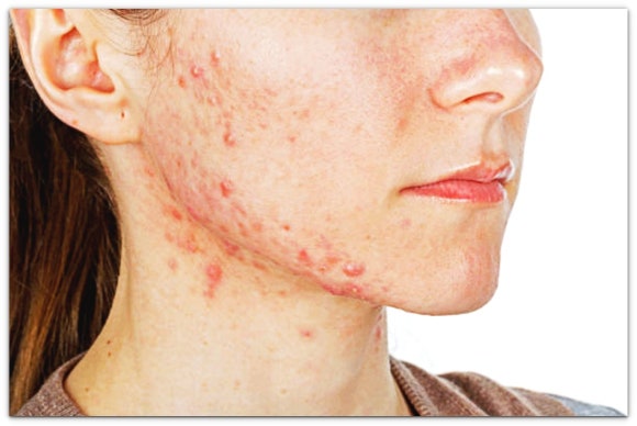 영등포여드름치료, 증상만 가라앉는다고 좋아지는 것이 아닙니다 관련 이미지 2