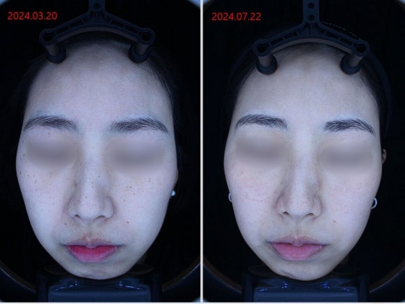 영등포 주근깨 레이저 치료 사례 관련 이미지 4