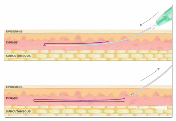 영등포실리프팅 3가지 오해를 해결해드립니다. 관련 이미지 2