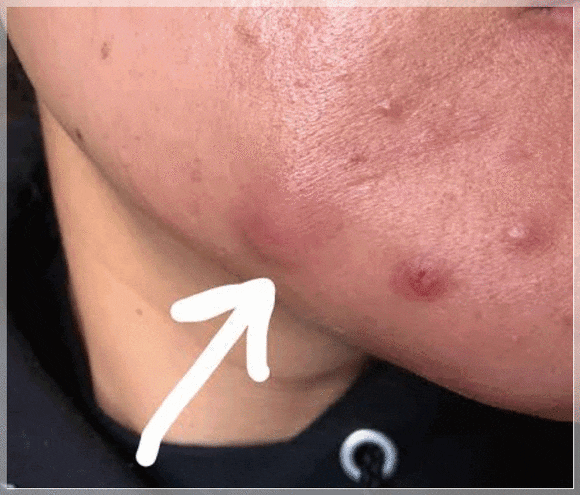당산역 피부과 염증주사, 언제 필요한 치료일까? 관련 이미지 1