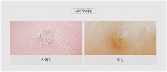 영등포사마귀, 피부 전염되는 이유와 관리 방법은? 관련 이미지 4