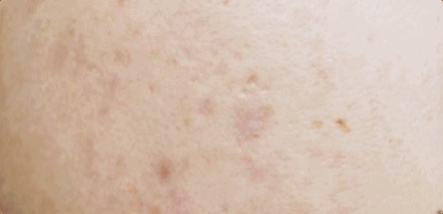 영등포 여드름흉터, 효과 보려면 이 방법부터 확인하세요 관련 이미지 3