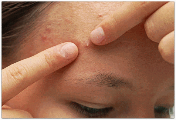 영등포여드름피부과 진료, 약 먹기 싫고 치료 통증 두렵다면? 관련 이미지 1