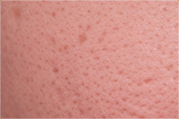 영등포 여드름흉터, 효과 보려면 이 방법부터 확인하세요 관련 이미지 4