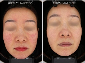 영등포 레이저토닝으로 홍조 치료한 사례 관련 이미지 4