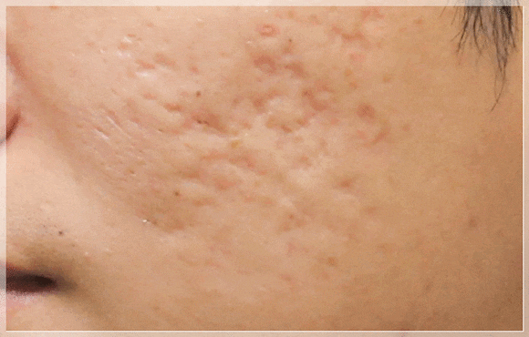 Yeongdeungpo Acne Scars: Which Treatment Does My Case Need? image 3