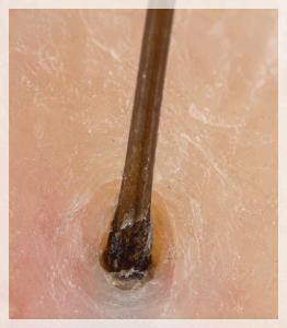 Dangsan Station Dermatology Clinic for Hair Removal, Why Treatment Suited to You Matters image 5