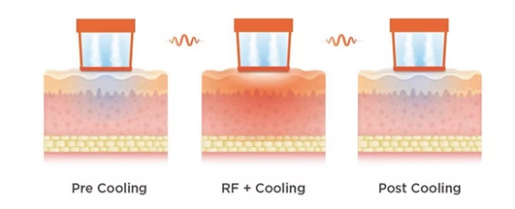 올리지오X 올리지오 개선사항 <300샷 효과> 관련 이미지 2