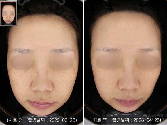 Yeongdeungpo Laser Toning: How Is Melasma That Developed After Childbirth Treated? image 8