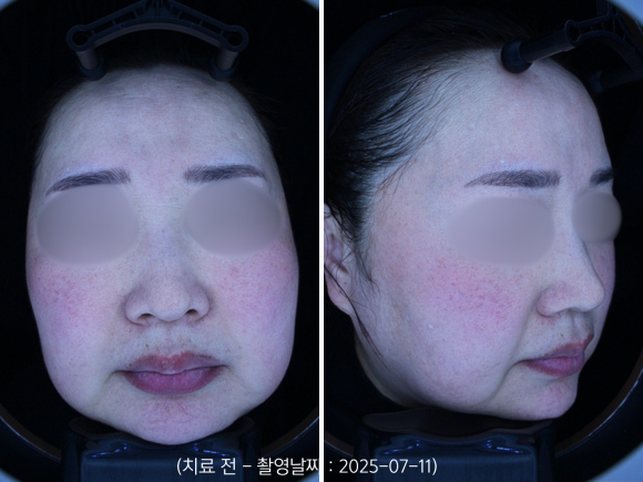 영등포 홍조치료, 안면홍조 레이저 받으면 붉은기가 좋아지나요? 관련 이미지 2