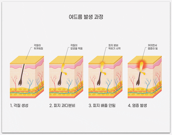 영등포여드름피부과 진료, 같은 자리에 자꾸 재발한다면? 관련 이미지 4