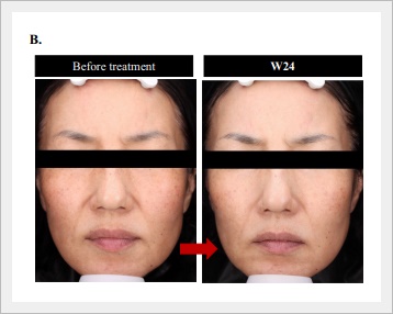 벨로테로 리바이브 효과와 부작용은? 관련 이미지 5