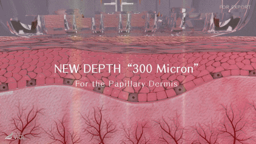 실펌x 레이저 효과 추천대상 통증은 어떨까? 관련 이미지 3