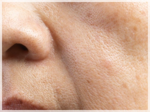 레스틸렌 스킨부스터 비탈라이트 효과는? 관련 이미지 4