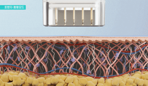 포텐자 펌핑팁 모공팁 무슨 차이가 있을까? 관련 이미지 5