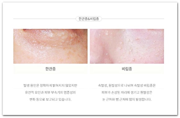 영등포비립종 한관종 편평사마귀 차이, 어린이도 제거 치료될까? 관련 이미지 2