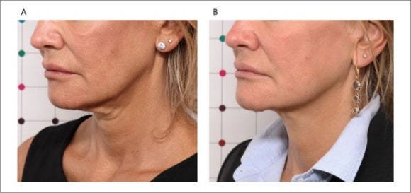 Yeongdeungpo Onda Lifting: Is it Effective for a Double Chin and Under-Chin Fat? image 6