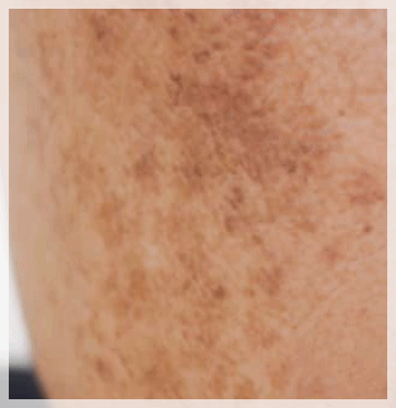 Mullae Dermatology Clinic: Differences in Skin Concerns You Should Know Before Your Appointment image 9