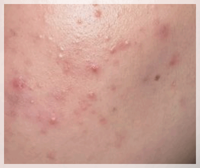 Mullae Dermatology Clinic: Differences in Skin Concerns You Should Know Before Your Appointment image 8